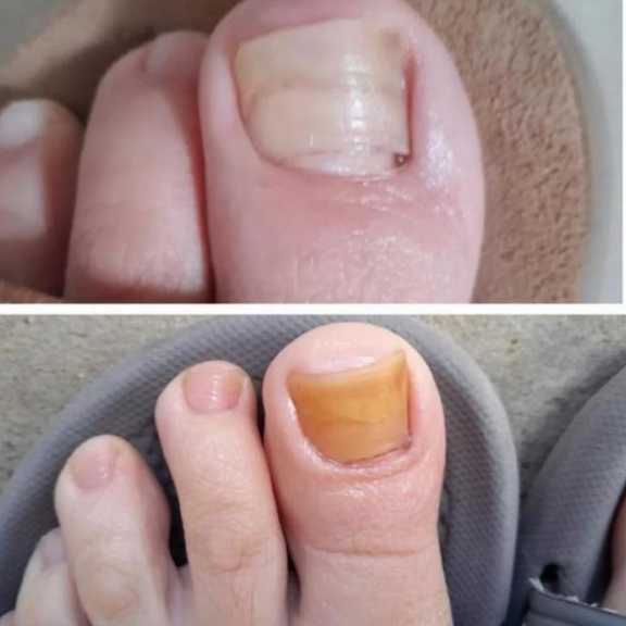 Crema Anti Hongos PLUS -30% DESCUENTO