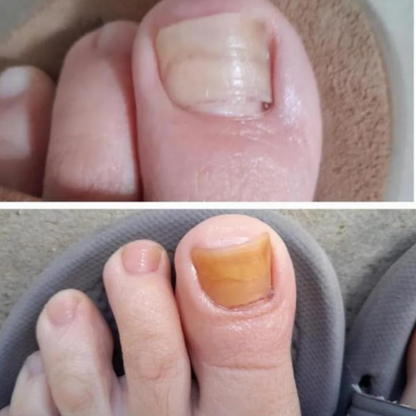 Crema Anti Hongos PLUS -30% DESCUENTO