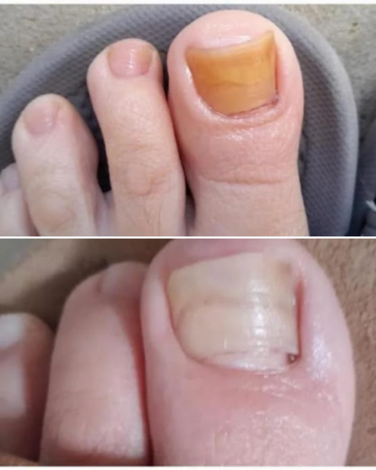 Crema Anti Hongos PLUS -30% DESCUENTO